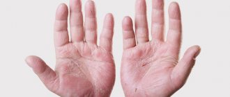 peeling skin on the palms causes, treatment and prevention