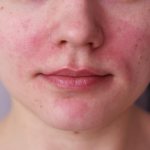 Facial skin peels and turns red. Causes and signs of diseases, treatment 