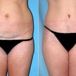Scars after abdominoplasty are located in the bikini area