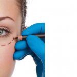 Modern methods of blepharoplasty - article on the topic Plastic surgery