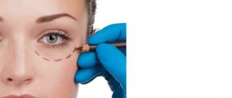 Modern methods of blepharoplasty - article on the topic Plastic surgery