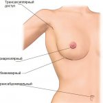 Methods of performing mammoplasty