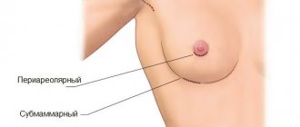 Methods of performing mammoplasty