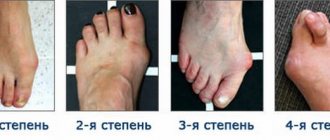 degree of foot deformation