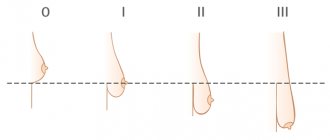 Degrees of mastoptosis (breast prolapse) according to Regnault