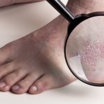 Dry skin on the legs. Causes of dryness, itching, peeling and cracks. Treatment and care for feet at home 