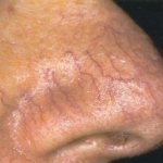 This is what skin with rosacea looks like