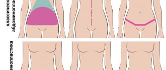 types of tummy tuck