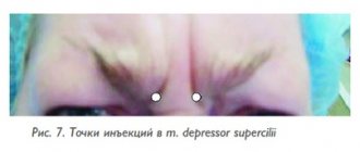 Injection points in m. depressors supercilii 