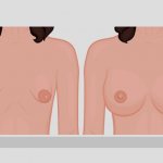 Tubular form of mammary glands, breasts. Photos, correction without surgery for women, men 