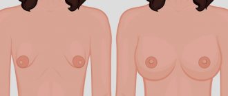 Tubular form of mammary glands, breasts. Photos, correction without surgery for women, men 