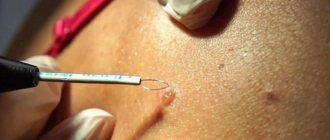Mole removal consequences