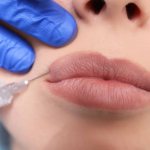 Lip augmentation with hyaluronic acid is painful
