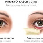 Incision options for lower blepharoplasty: transcutaneous and transconjunctival