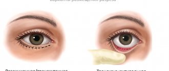 Incision options for lower blepharoplasty: transcutaneous and transconjunctival