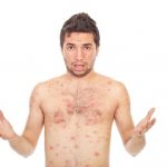 chickenpox in a man