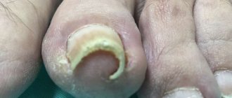 Ingrown nail. Surgical removal of an ingrown toenail in Moscow 
