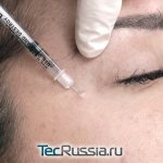 botulinum toxin injection by a cosmetologist