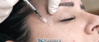 botulinum toxin injection by a cosmetologist